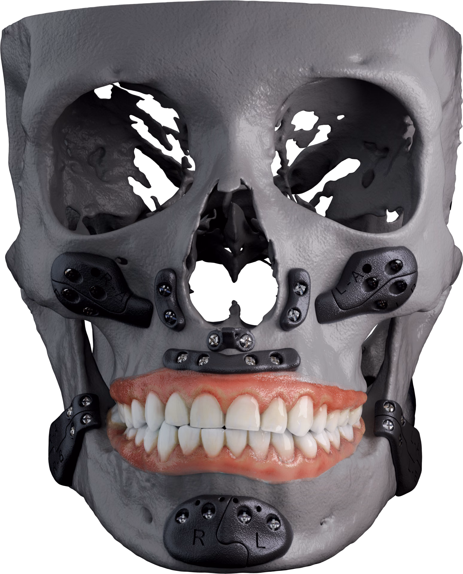 Aesthetic facial implants positioned on an anatomical skull model, front view