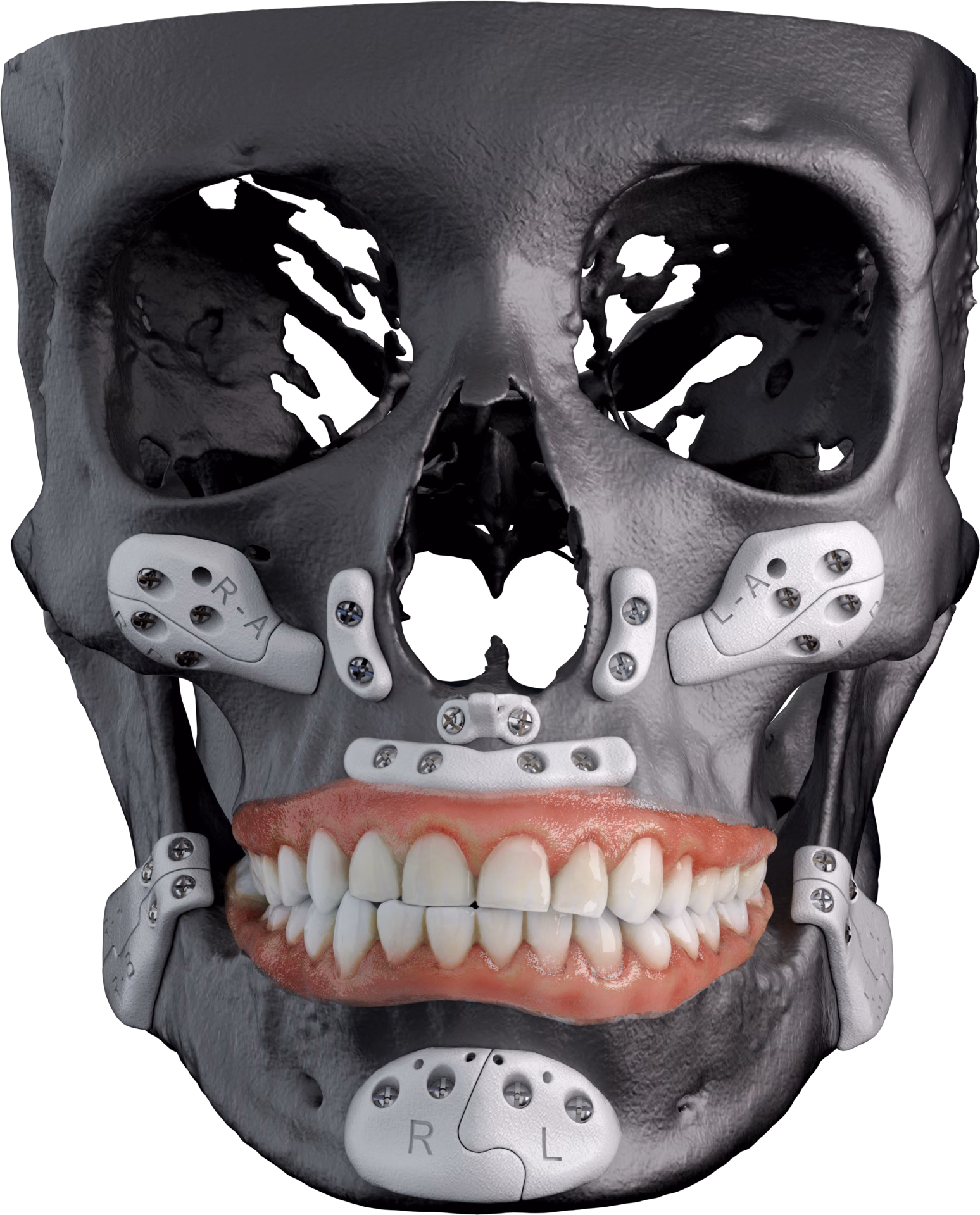 Impianti facciali estetici posizionati su un modello di cranio, vista frontale