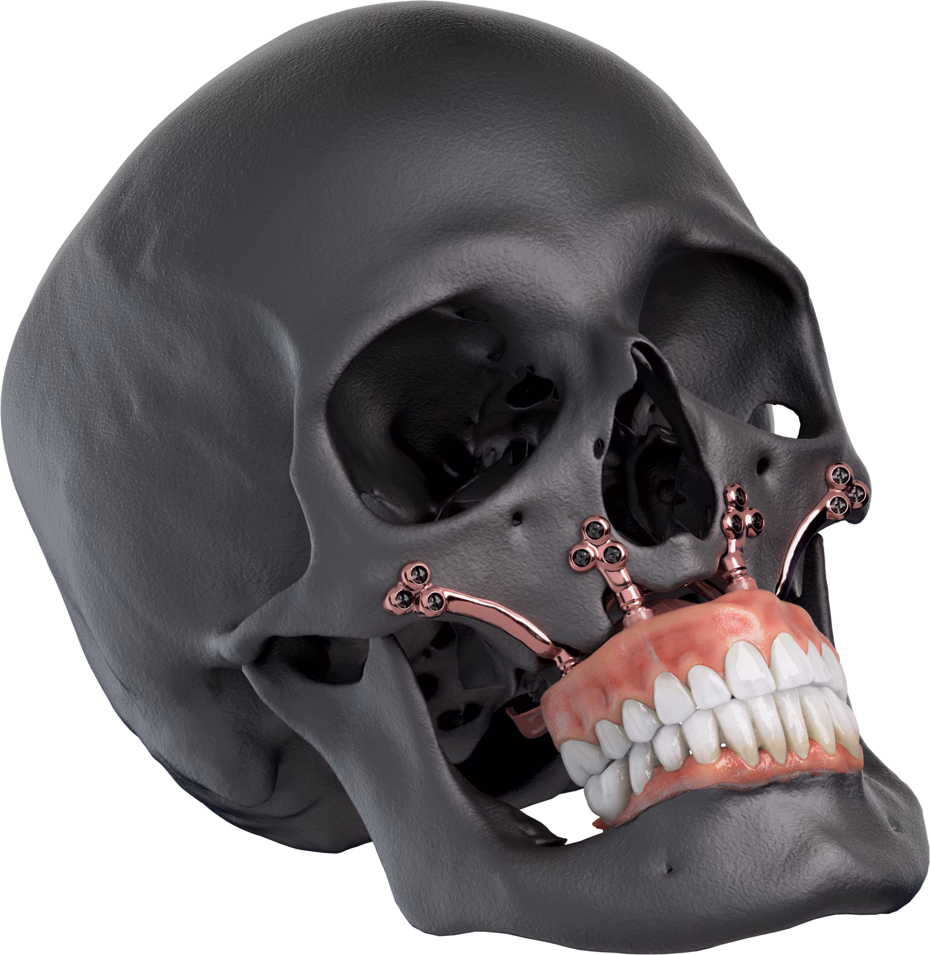 Render of an All On One maxillary configuration on an anatomical skull