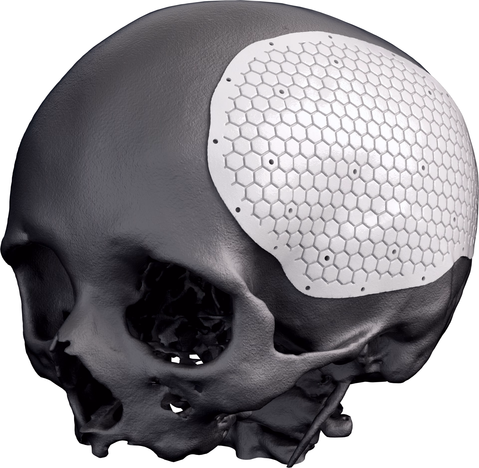 Rete per cranioplastica su un modello di cranio, vista a tre quarti